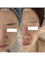 エステティック リベル キョウト 京都駅前店(Esthetic Liber Kyoto)&nbsp;【肌質改善ピーリング】