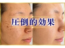 ボーテヌール(Beaute Nheur)/肌プログラムPro
