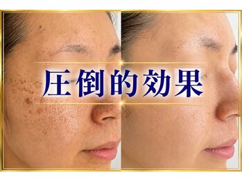 ボーテヌール(Beaute Nheur)/肌プログラムPro