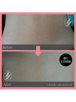 ブロンズ(BRONZE)/腰