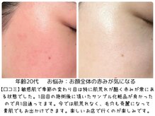 パルテール/お顔の赤みがお悩み【口コミ】