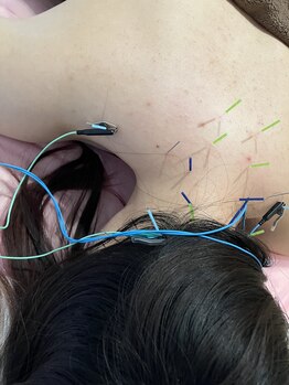 瑞 鍼灸院/頭皮鍼+美容鍼