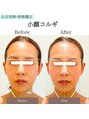 ジーンバイピエル 中野店(gene by PIEL)&nbsp;コルギの1回目で、左右のバランスが良くなりました。