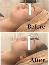 スペチアーレ 夙川/リフトアップ、法令線暖和に