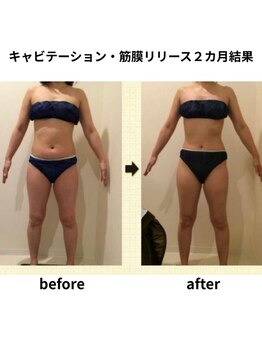 クリア(Clear)/キャビテーション・筋膜リリース