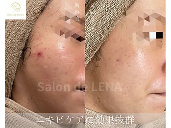 サロンドレナ 名駅店/ハーブピーリング サロンドレナ