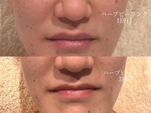 ウルル 上野店(ULULU)の雰囲気（繰り返し起きるニキビを予防！）