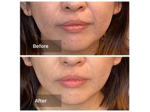 アオダモ(aodamo)の雰囲気（たった一度でこの変化！テラボーラー後は手のひらに収まる小顔に）