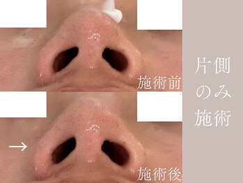 ハネ 自由が丘(Hane)/[自由が丘/インディバ/術後ケア]