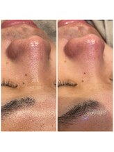 アルカディア(Arcadia)/メンズフェイシャル