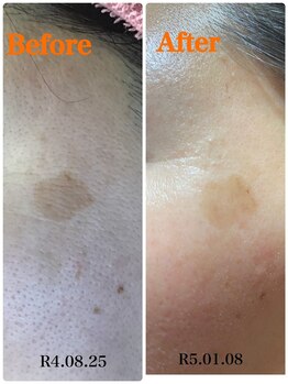 ソレイユ/光フェイシャル エステ 美肌