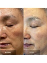 サンポ 神戸元町店(SANPO)/ヒト幹細胞培養上清液ケア