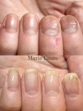 マリーロール 淀屋橋本店(Marie Laure)/自爪育成/深爪矯正/ネイルケア