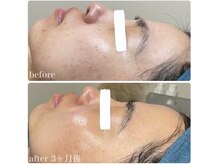 ちらちゅら/クリスティーナ【施術経過】