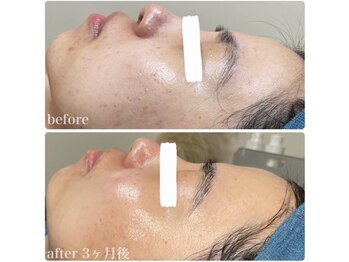 ちらちゅら/クリスティーナ【施術経過】