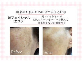 アルゴ 熊本玉名店(ALGO)/光フェイシャルでシミケア◎