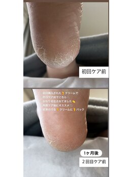 フットミー(foot mii)/ケア前比較
