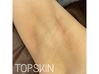 トップスキン 表参道(TOPSKIN)/ボディハーブピーリングも大人気