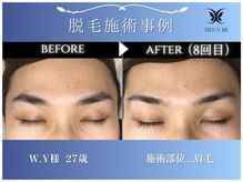 メンズビービー 福井高柳店(MEN'S BB)/眉毛脱毛施術事例
