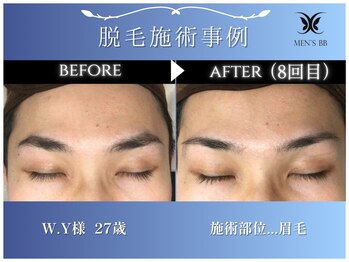 メンズビービー 福井高柳店(MEN'S BB)/眉毛脱毛施術事例