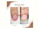 ８ヶ月の軌跡！深爪・自爪 育成