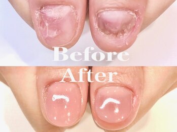 深爪矯正で美爪に！春にピッタリ