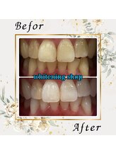 ホワイトニングショップ 宇都宮店/Before&After美白ホワイトニング