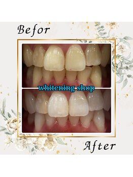 ホワイトニングショップ 宇都宮店/Before&After美白ホワイトニング