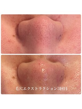 ヒメミ(Himemi)/毛穴エクストラクションtete式