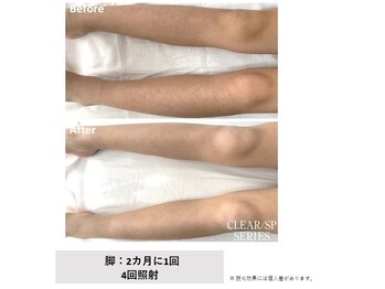 スプレール 水戸店/ジュニア脱毛