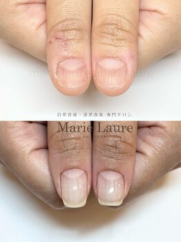 マリーロール 淀屋橋本店(Marie Laure)/自爪育成/深爪矯正/ネイルケア