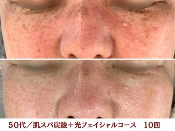 アリィ エステティック(allie esthetic)/【肌スパ炭酸＋光フェイシャル】