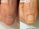 自爪育成・深爪・川崎