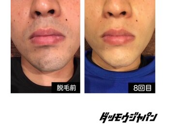 ジャパン 東広島店(JAPAN)/【ヒゲ脱毛 Before → After】