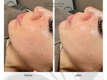 アン ビューティー(ann beauty)/施術1回【症例写真】20代