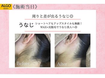 アルゴ 豊中岡町駅前店(ALGO)/【うなじ脱毛 WAX大人気パーツ】
