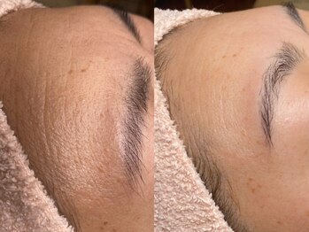 ブラジリアンワックス脱毛フェムケア 毛穴小顔美白専門 Salon de Noel 神戸三宮店/美白ワックス脱毛(Before/After)