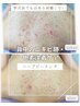 【美背中計画♪】美肌ハーブピーリング(背中)