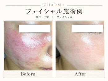 チャームプラス(CHARM+)の写真/神戸三宮で毛穴・ニキビ・赤みを徹底ケア◇肌質改善フェイシャル・ハーブピーリング・メンズ対応・個室完備