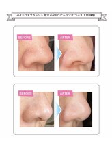 アクアプラス(AQUA+)/ブラックヘッドもスッキリ◎