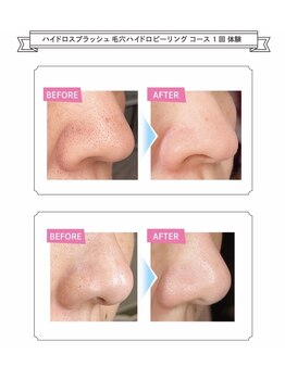 アクアプラス(AQUA+)/ブラックヘッドもスッキリ◎