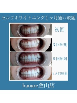 オンディーヌ ハナレ 名古屋店(HANARE)/白くするなら通い放題がおすすめ