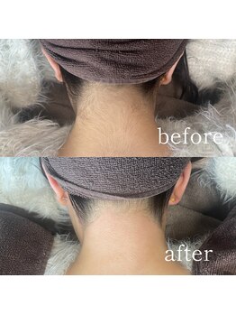 ムート(Mut.)/うなじワックス＋光脱毛。