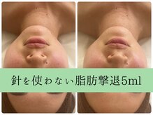 ソルニスデュオ(Solnis.-duo-)/小顔/酵素浴/ハイパーナイフEX2