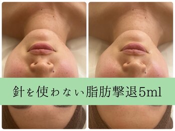 ソルニスデュオ(Solnis.-duo-)/小顔/酵素浴/ハイパーナイフEX2