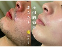 アルゴ 八幡黒崎店(ALGO)の雰囲気（【メンズ/レディース完全別室】ヒゲWAX＋APL脱毛）
