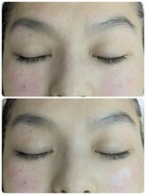 マインドール/赤み、目頭眉頭シワ緩和