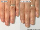 自爪育成・深爪・川崎