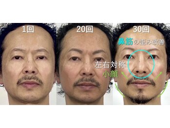 ラプリ 横浜店(Raplit)/隆鼻+輪郭矯正40分