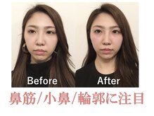 ラプリシュシュ 岡山店(Raplit)/隆鼻＋輪郭矯正40分10回